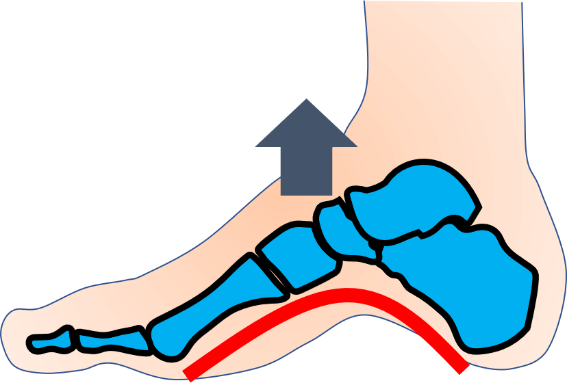 外反母趾以外に足の痛みで多い症例６つ