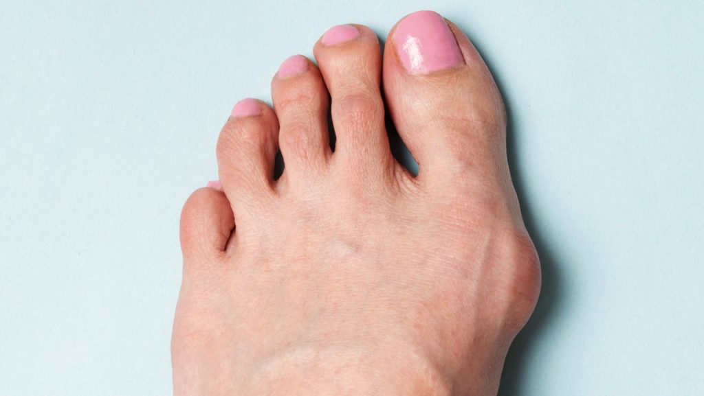 外反母趾や内反小趾は足そのものを変える必要がある