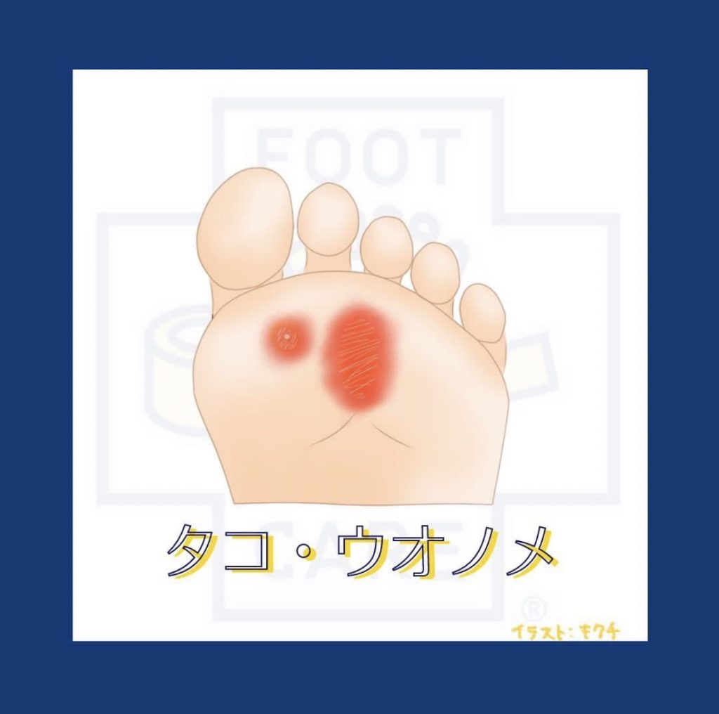 タコや魚の目が繰り返す方はなぜ起きているかに着目しましょう