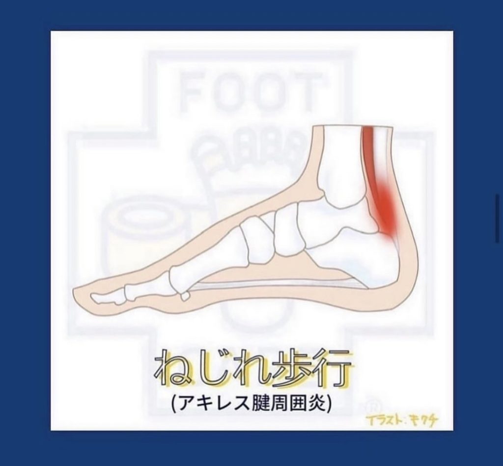 足のゆびの機能が低下すると真っ直ぐ蹴り出して歩けなくなる