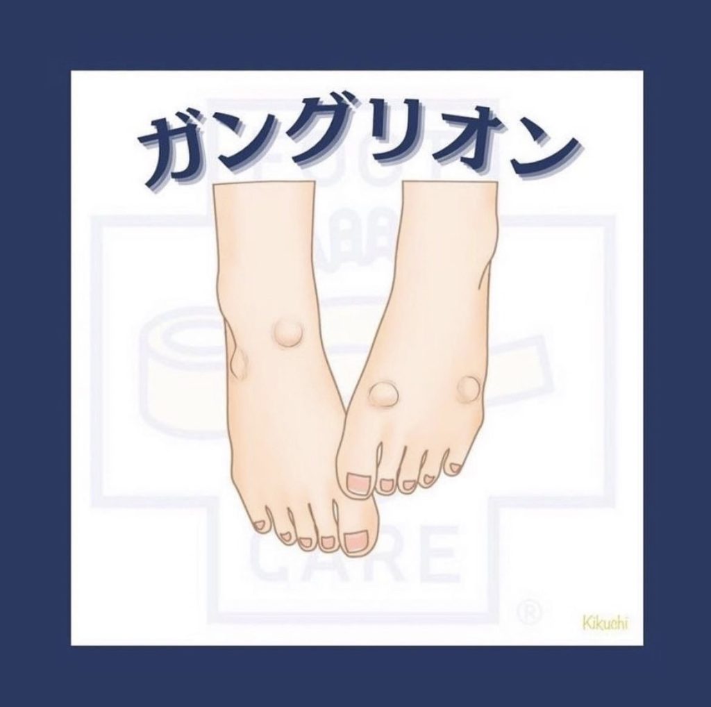 熊本で多い足の「ガングリオン」｜原因・症状・予防法と整体での改善ポイント