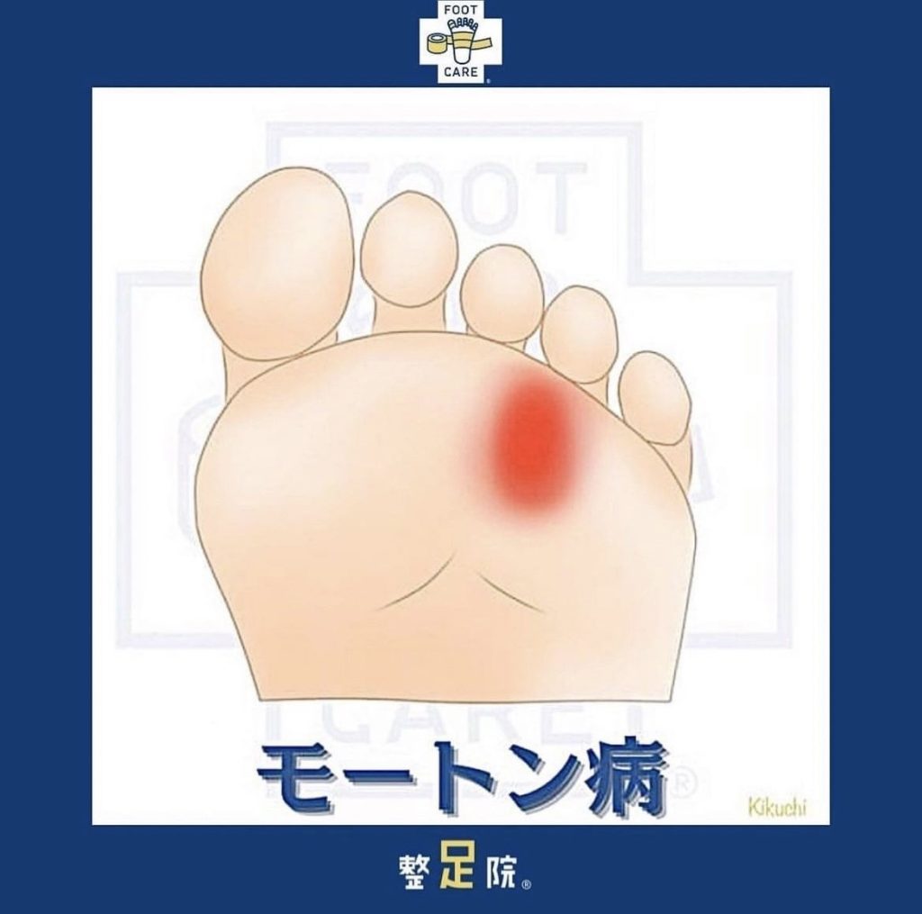 熊本でモートン病にお悩みの方へ｜足のしびれ・痛みの原因は「浮きゆび」かもしれません｜整足院 熊本店