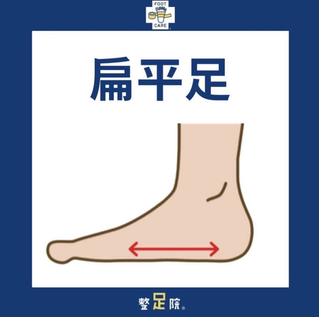扁平足によりどんな悪循環が繋がっていくのか？