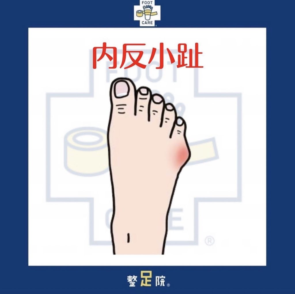 熊本で増えている「内反小趾」とは？原因・症状・放置のリスクと整足院でできる対策を解説