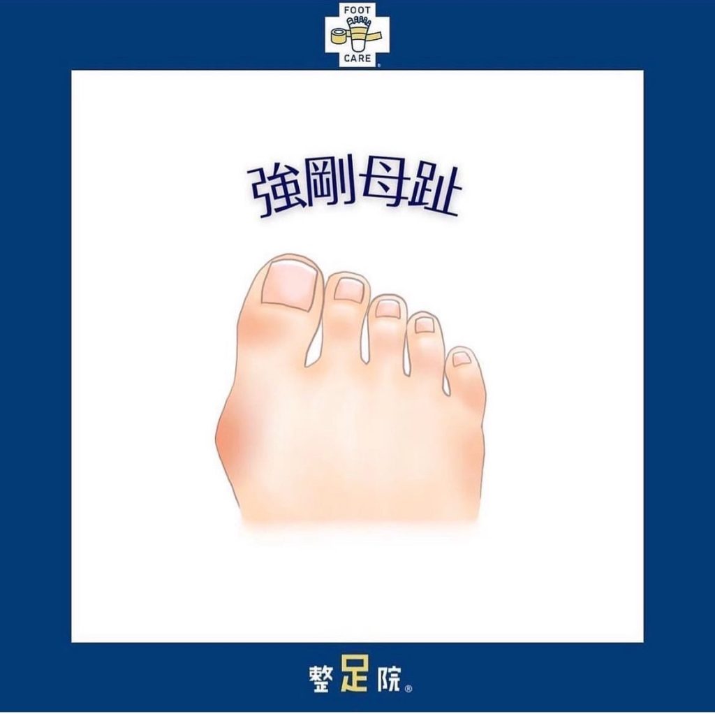 熊本で足の親指付け根が痛い方へ｜強剛母趾の症状・原因・改善法