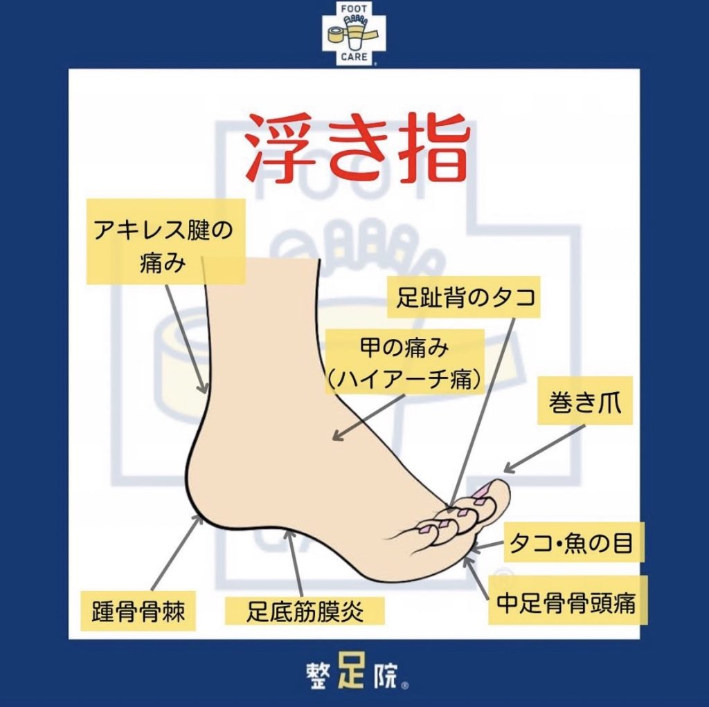 みなさんは「浮きゆび」をご存知ですか？