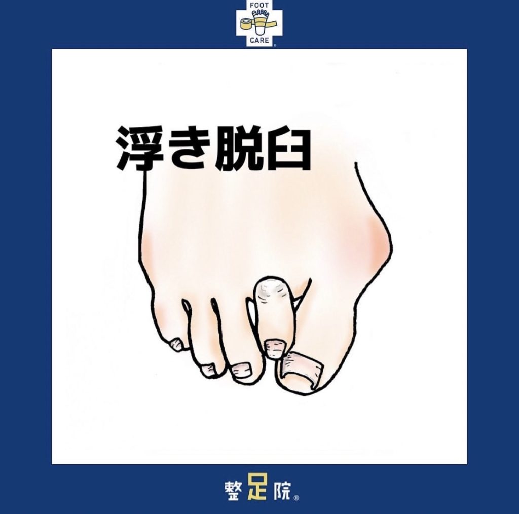 浮きゆび・外反母趾が悪化していくと！？