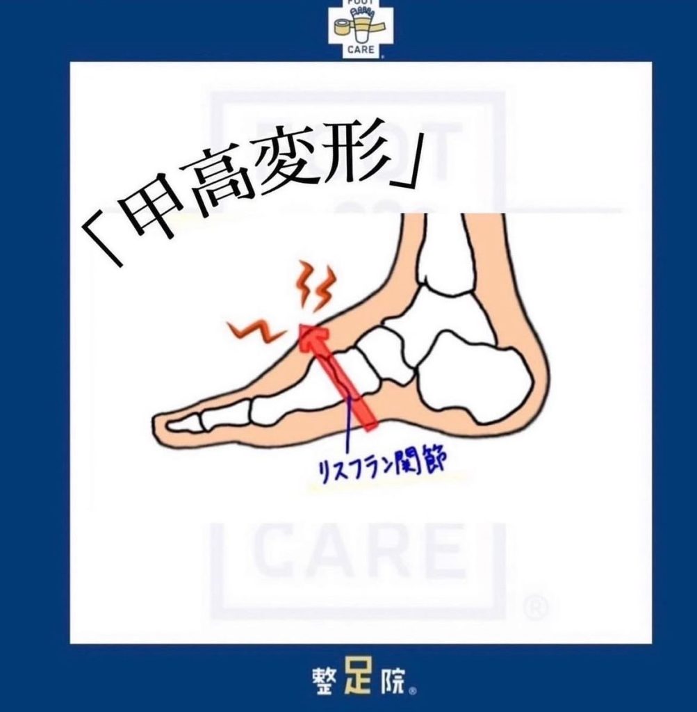 足の甲が高く変形している方はいませんか？