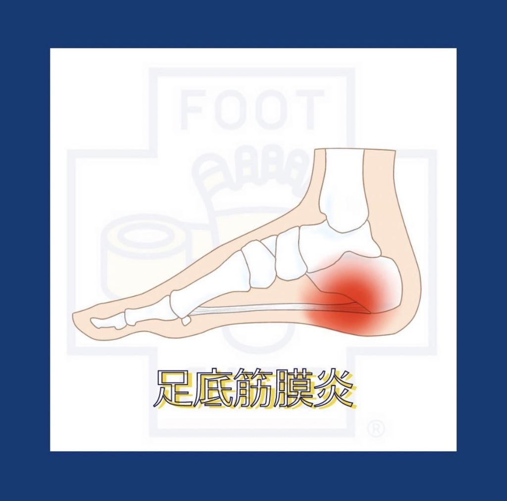 【熊本｜足底筋膜炎】朝一番の「ズキン！」は要注意！悪化させないための根本改善とは？