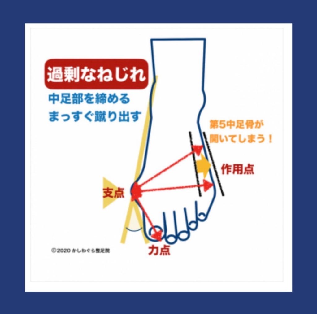 外反母趾の方の足は「過剰なねじれ」が起きているのも特徴