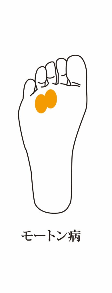 モートン病について詳しく説明します