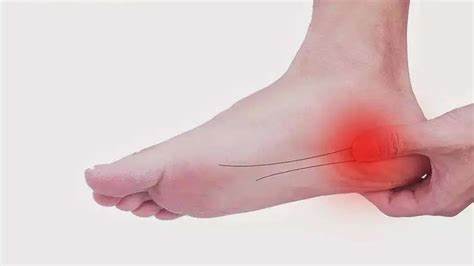 足底筋膜炎について解説いたします