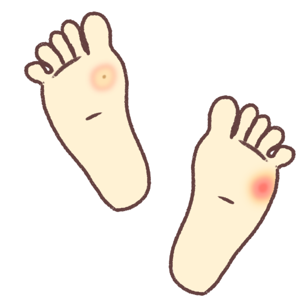 足に出来るタコと魚の目の違いについて