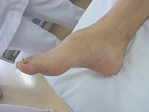 足の甲高変形について解説いたします